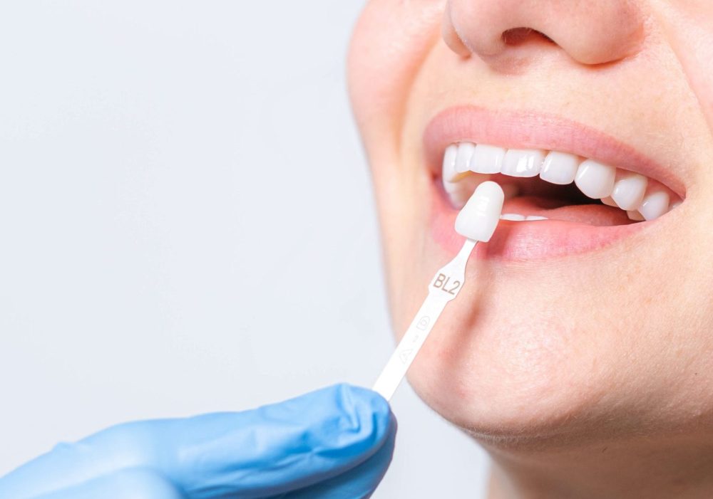 Banner tooth whitening, perfect white teeth close up with shade guide bleach color, female veneer smile, dental care and stomatology, dentistry, copyspace.